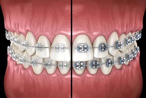 ceramic clear brackets vs metal brackets for braces|difference between aligners and braces.